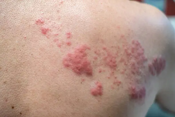 Best Homeopathic Doctor in Multan Homeopathic treatment for skin conditions in Multan
